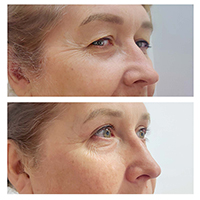 Блефаропластика верхних век